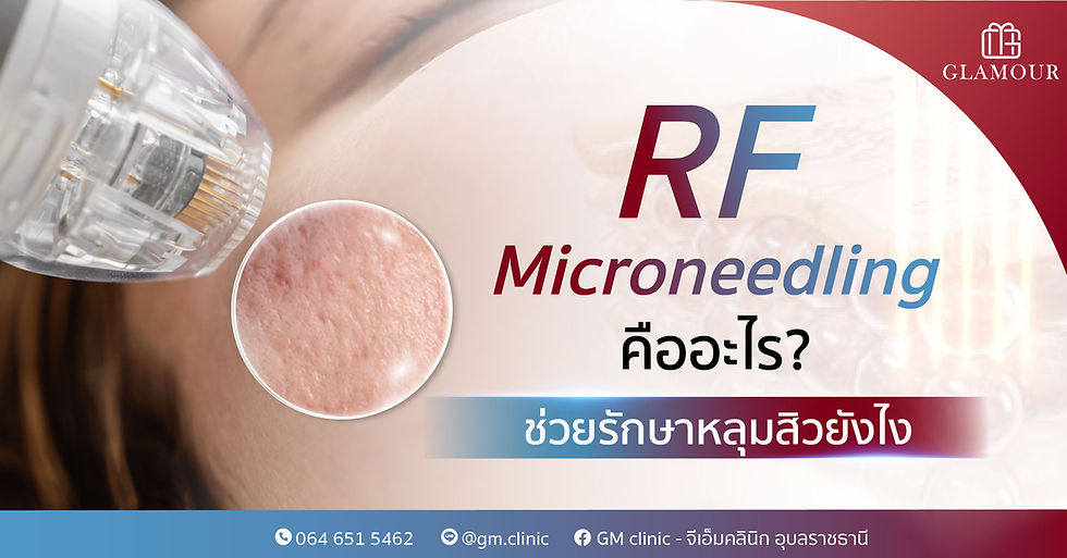 RF Microneedling คืออะไร? ช่วยรักษาหลุมสิวยังไง