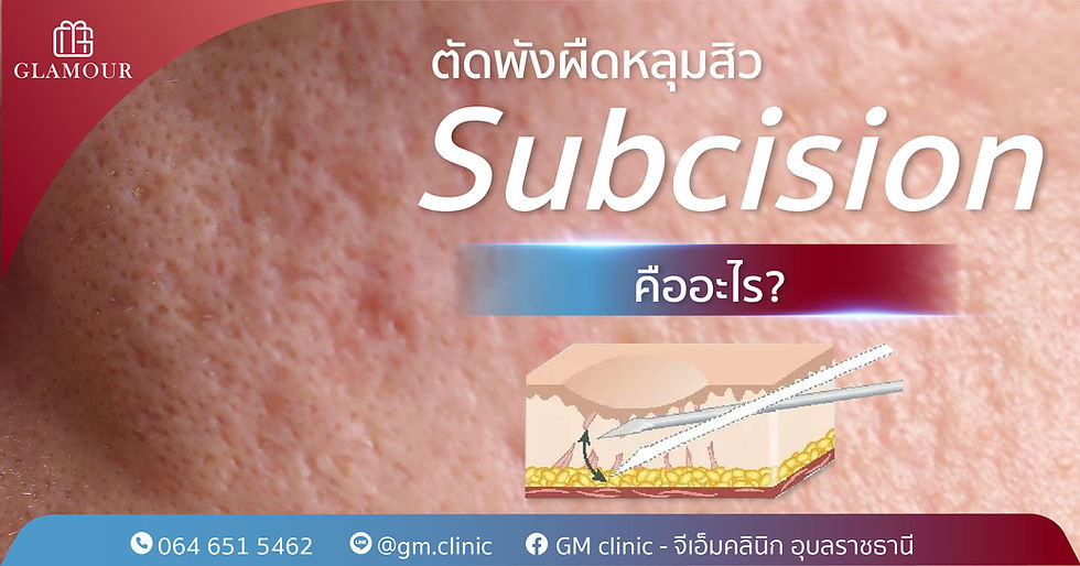 Subcision คืออะไร? วิธีตัดพังผืดหลุมสิวที่ช่วยให้หลุมลึกดูตื้นขึ้น