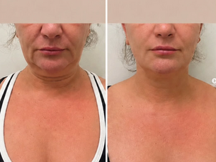 XERF face tightening before and after