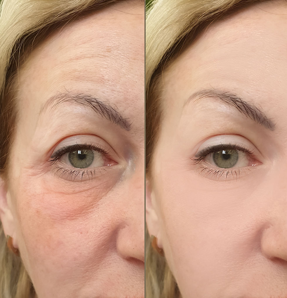 botox-results-1
