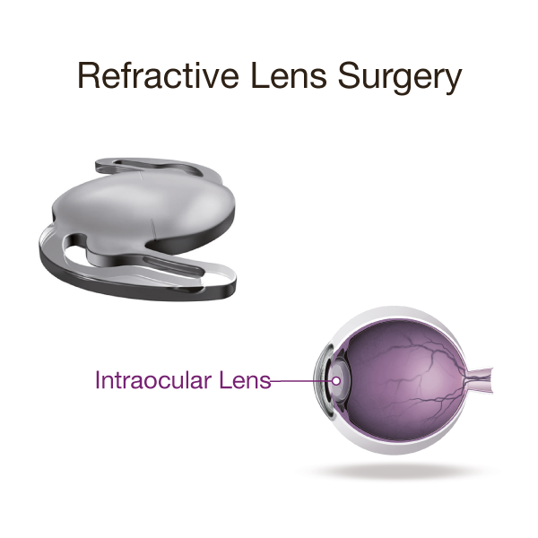 Refractive-Lens-Diagram.png