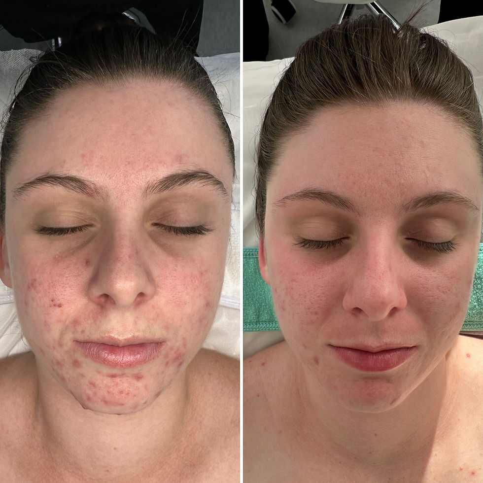 Acne progress mid-treatment