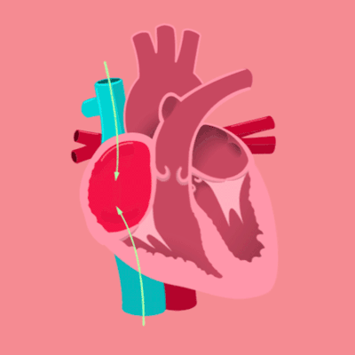 Hipertensión arterial | nurshibo