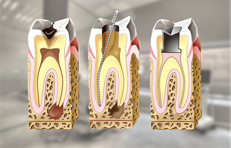 endodoncias.gif