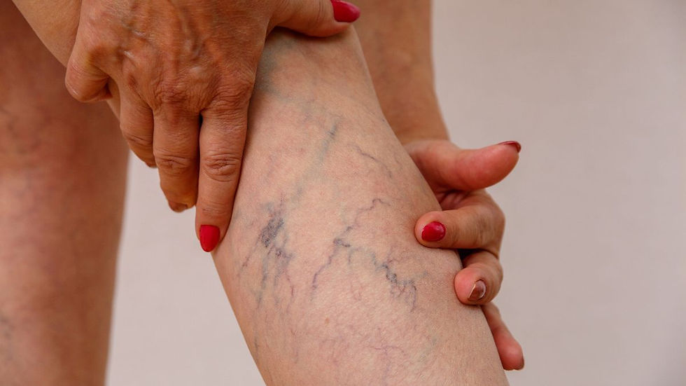 Sclerotherapy | What to Expect and How to Get the Best Results