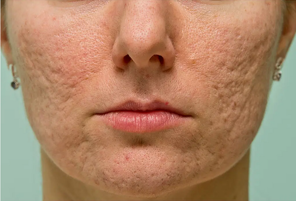 acne scar.PNG
