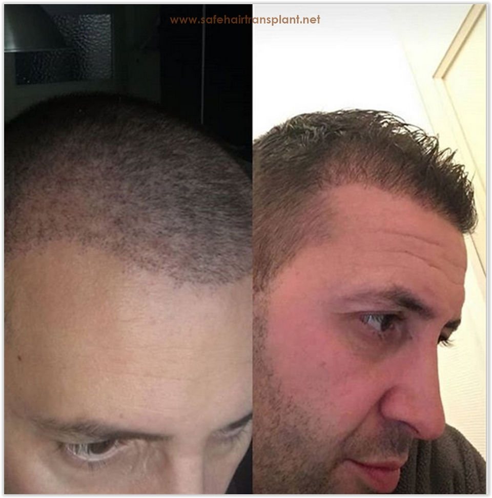  توصيات زراعة الشعر في تركيا 2019