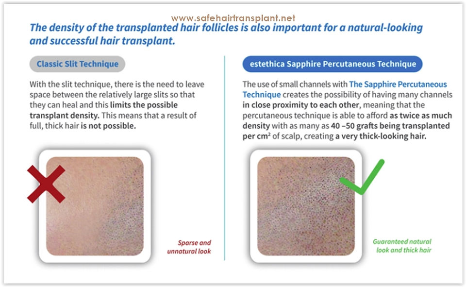 How to go to Turkey/Istanbul for hair transplantation?