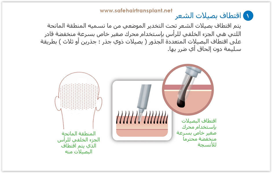 زرع الياقوت الشعر