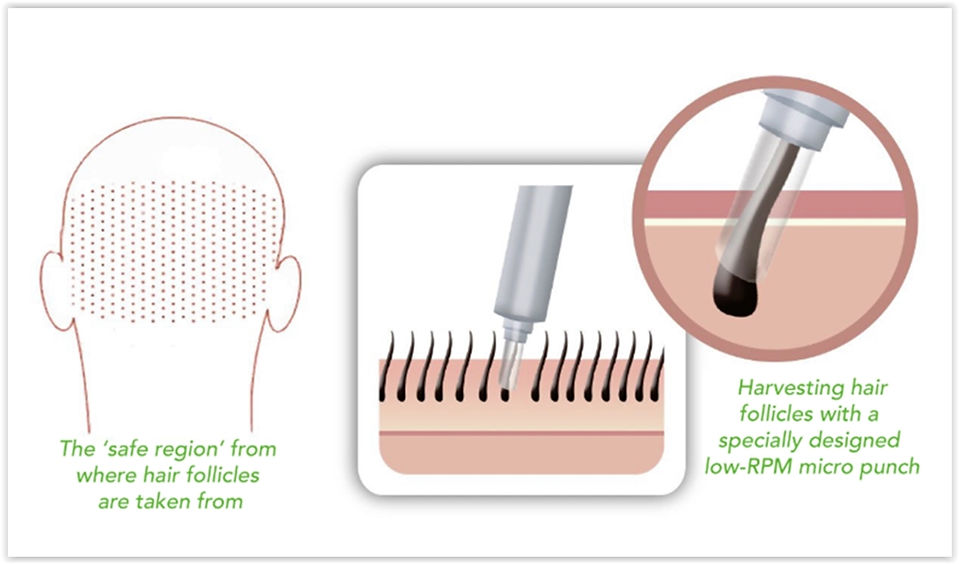 The best hair transplant turkey 2019