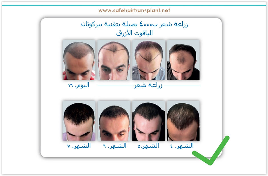 زرع الياقوت الشعر