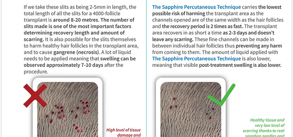 Shappire Hair Transplant