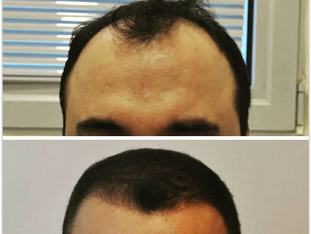 زراعة الشعر تركيا قبل وبعد