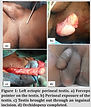 Perineal Ectopic Testis_final-2 figure 1