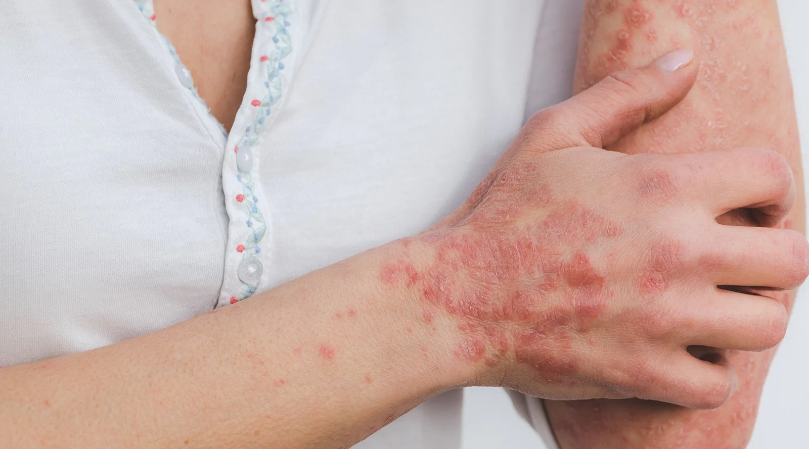 psoriasis.webp