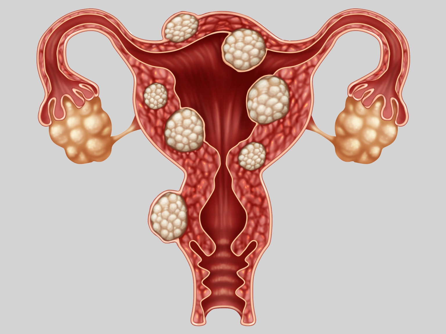 hirslanden-illustration-endometeriose-uterus.webp