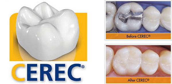 CEREC-crown.jpg