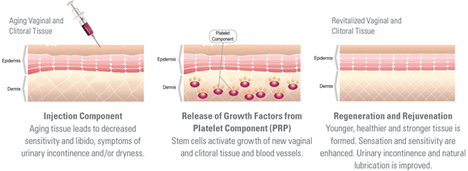 Incontinence relief Improved Sexual function