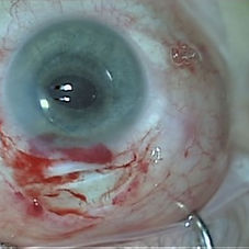 Dislocated lens3.jpg