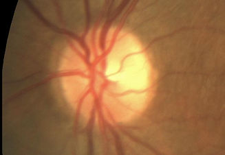 Normal Optic Nerve.jpg