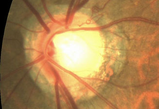 Glaucoma.jpg
