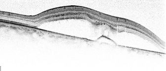 OCT Scan of Fluid BU.jpg