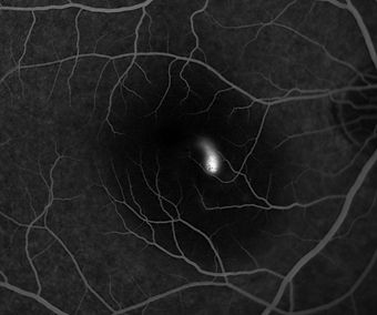 Fluorescein Angiogram01.jpg