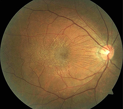 Membrana Epirretiniana