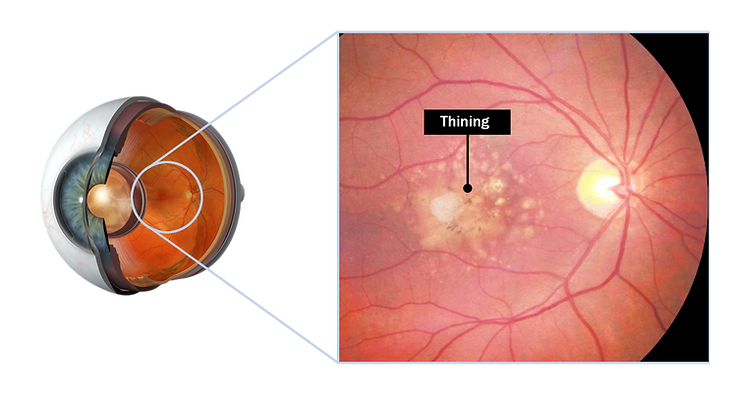 Epiretinal Membrane02.png