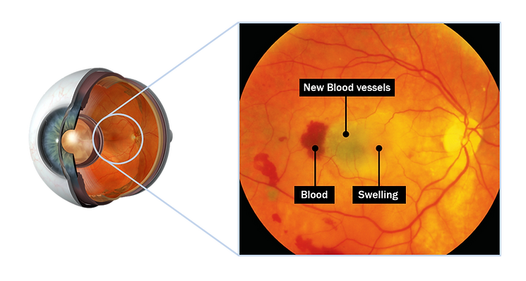 Wet macular Degeneration.png