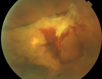 Diabetic Retinopathy.jpg