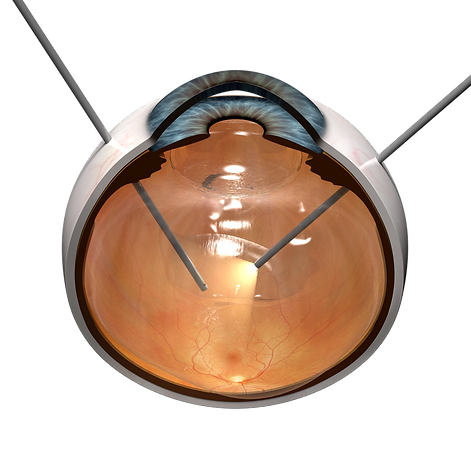 vitrectomy01.png