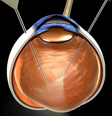 Vitrectomy.jpg