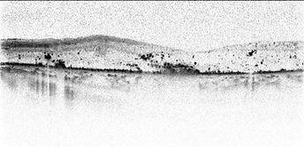 macular swelling_BW02.jpg