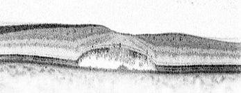 fluorescein angiography_before treatment