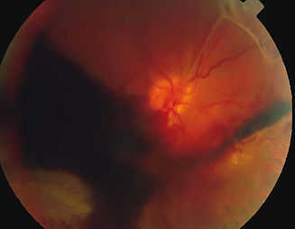 Vitreous haemorrhage.jpg