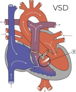 VSD_edited.jpg