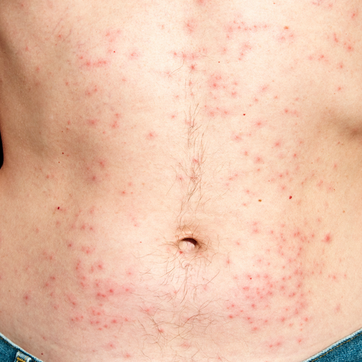  Dicas eficazes para eliminar a foliculite