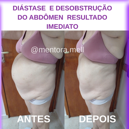 "Antes e depois do tratamento de diástase abdominal mostrando a recuperação da musculatura e redução da barriga estufada"