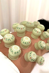 A man receiving traditional cupping therapy on his back