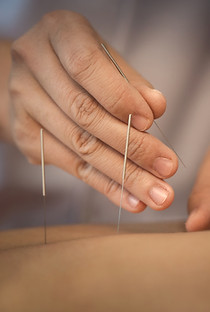 Close-up of acupuncture needles and the acupuncturist's hands