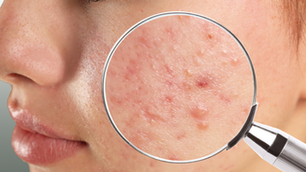 Webinar: Acne revisitada