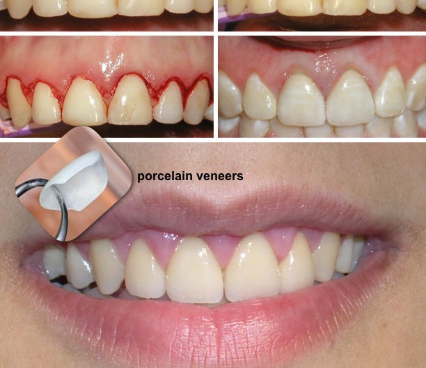 Wonder how porcelain veneers are made?