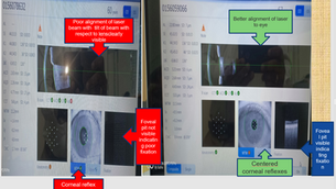 Patient Fixation with IOL Master 700 Biometry