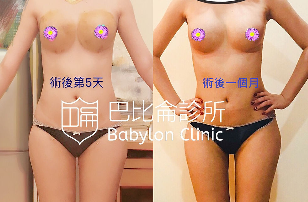 自體脂肪隆乳