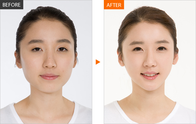 Face Bone Contouring content media