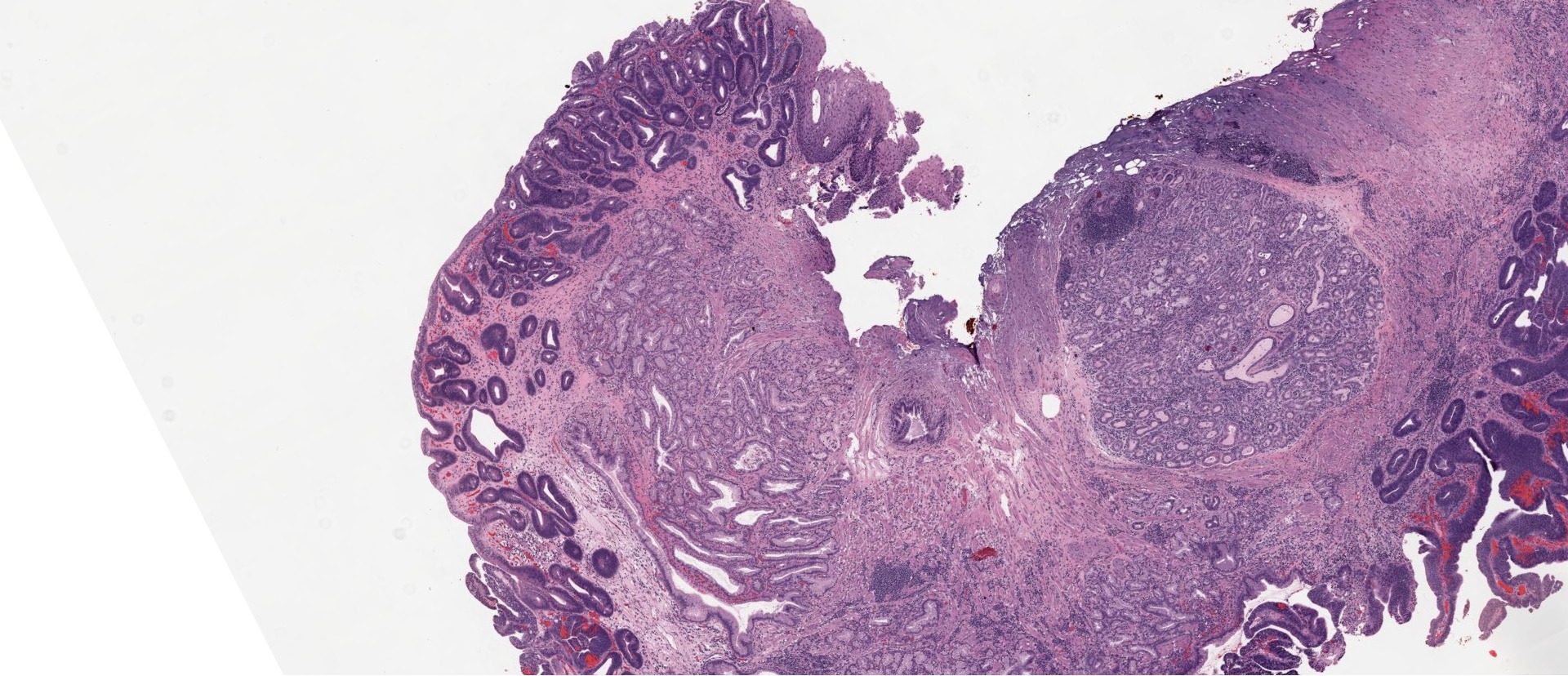 colonic mucosa minimal crypt irregularity