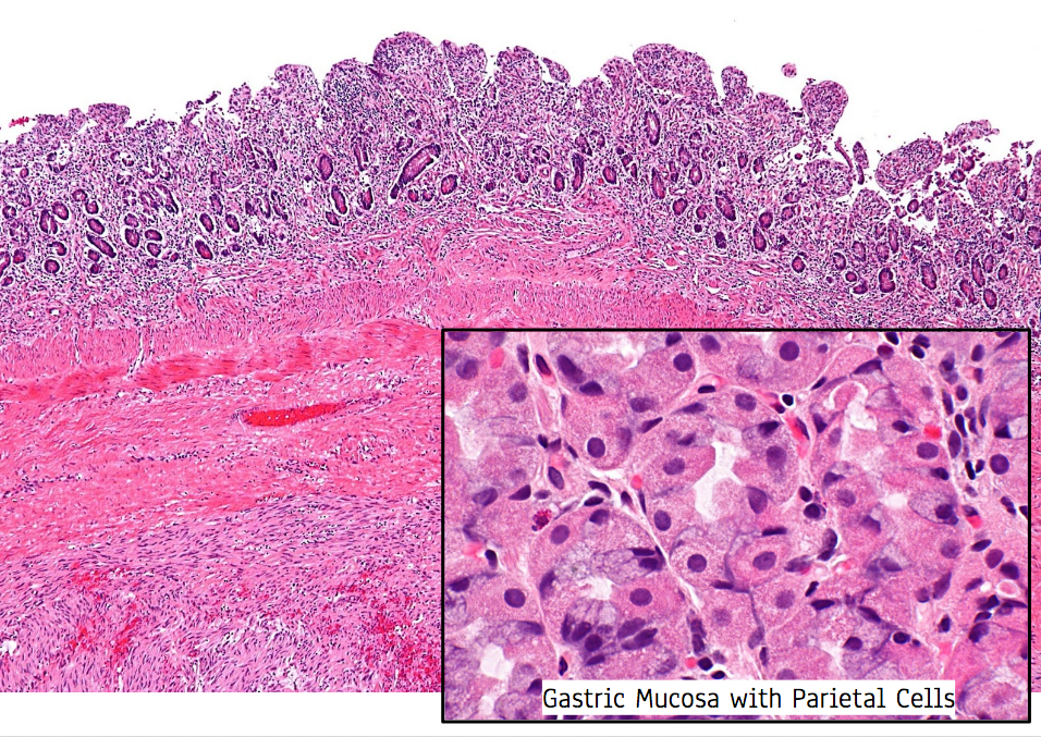 High Yield GI Pathology Esophagus GERD & Barrett Metaplasia