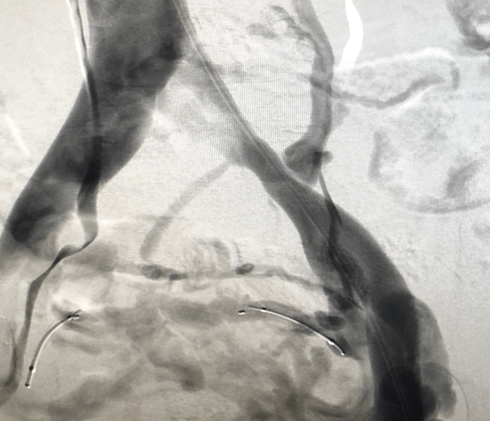 Treating and Managing Pelvic Congestion Syndrome (PCS)