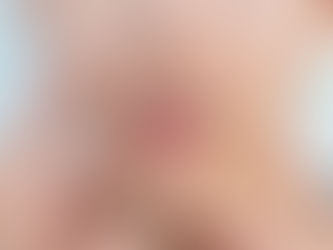 Você conhece a nova ACNE?